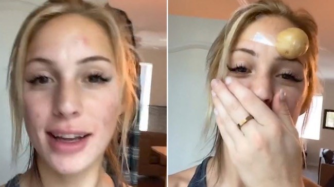 I used raw potato to treat my acne because of a TikTok trend